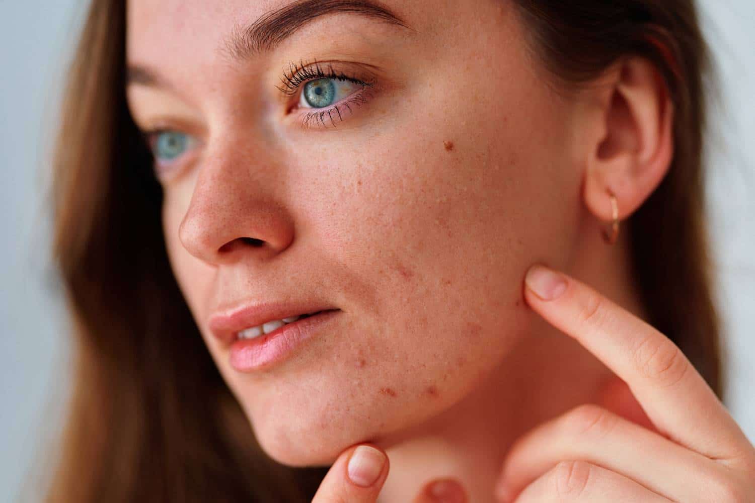 Types and Causes of Facial Spots | Toskani